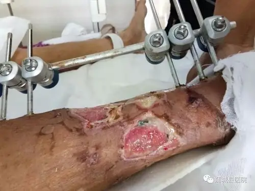 【有故事的县医院】困难群众突遭车祸,截肢?保肢?看蒲医人是怎么做的