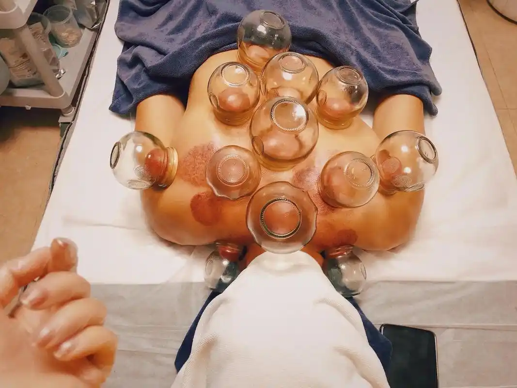 這双小手生下来一定是用來拯救人類的.#拔罐养生#拔火罐  這 - 抖音