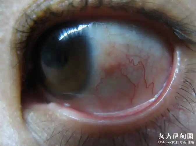 视力窃贼偷走视力的眼病青光眼提早诊断三步走