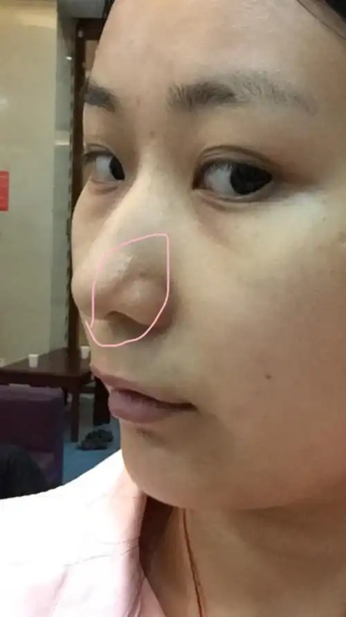 医生解答:您说的是一种非常典型的情况,在鼻子上由于皮脂腺的增生
