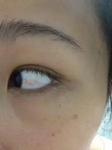 有人做过眼睛的睑裂斑手术没?请教下!