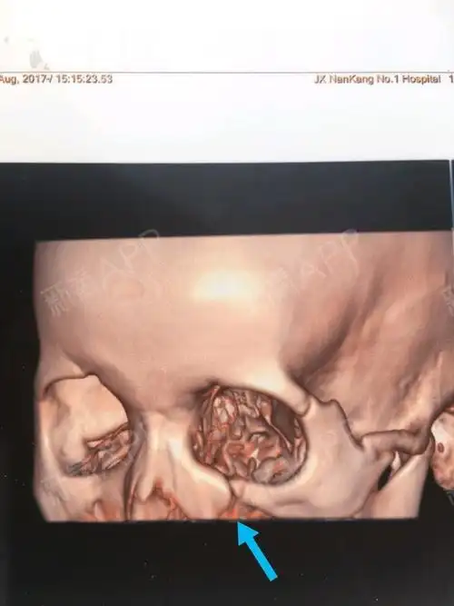 交通事故左颧骨骨折,至今八个月了,左脸有点塌陷下垂_圈子-新氧美容