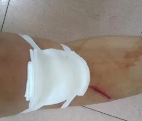 梦见自己小腿受伤流好多血是什么意思
