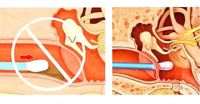 挖出巨大耳屎的满足感,医学专家打破你看挖耳屎视频的美梦!