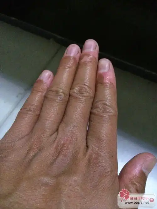 求大家帮帮忙,手指有白癜风这样治疗可以吗?