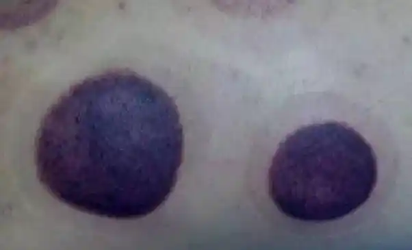 有水珠者—— 寒湿重水泡,水肿,潮湿——寒症,湿气盛皮肤微痒——风邪