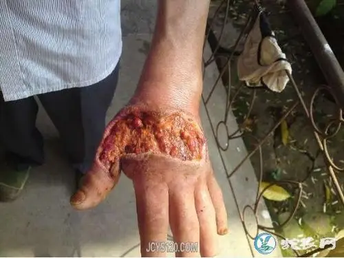 下面我们来给大家分享一下各种蛇伤图片,了解一下毒蛇咬伤后有多恐怖.