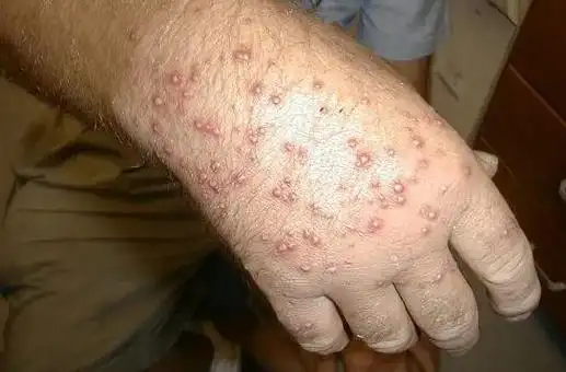 带娃去户外当心6类毒虫尤其第一种严重可致命