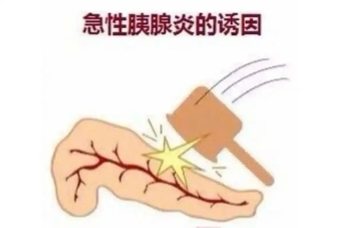 急性胰腺炎的主要症状是突然发作的持续性上腹部疼痛,可伴有恶心