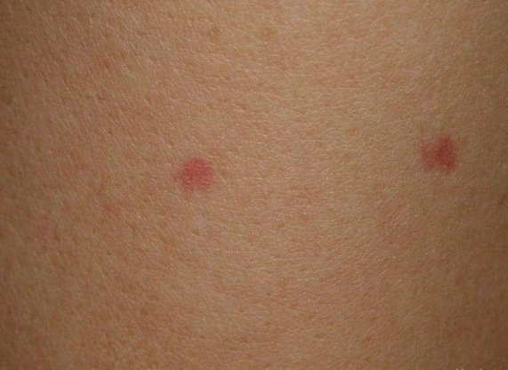 蜘蛛痣图片 (24)