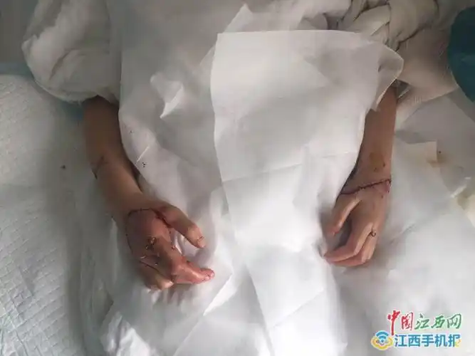 奉新砍人事件追踪:伤者被砍断双手已接上 恢复良好(图)