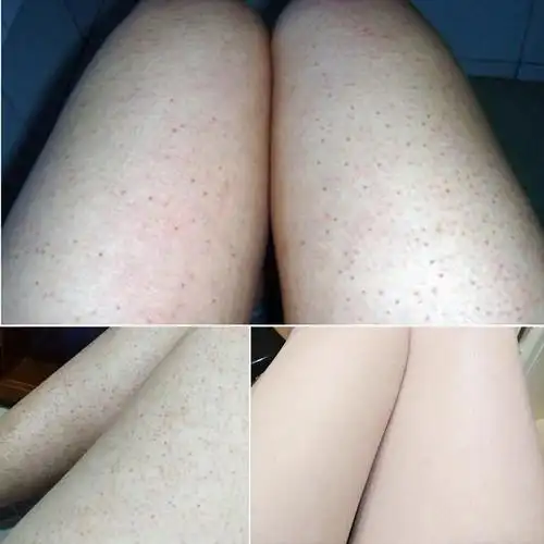 脖子鸡皮肤去除毛孔堵塞疏通身体去鸡皮毛周角化修护保湿腿上祛除