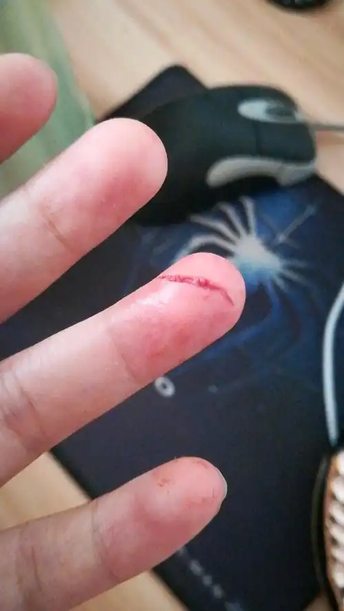 孕妇手被水果刀破了流好多血