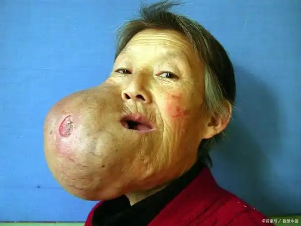 如何区分肿瘤的良恶性?