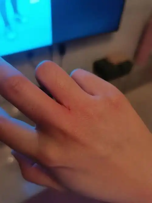 跳操太用力手自己被自己的指甲划伤了