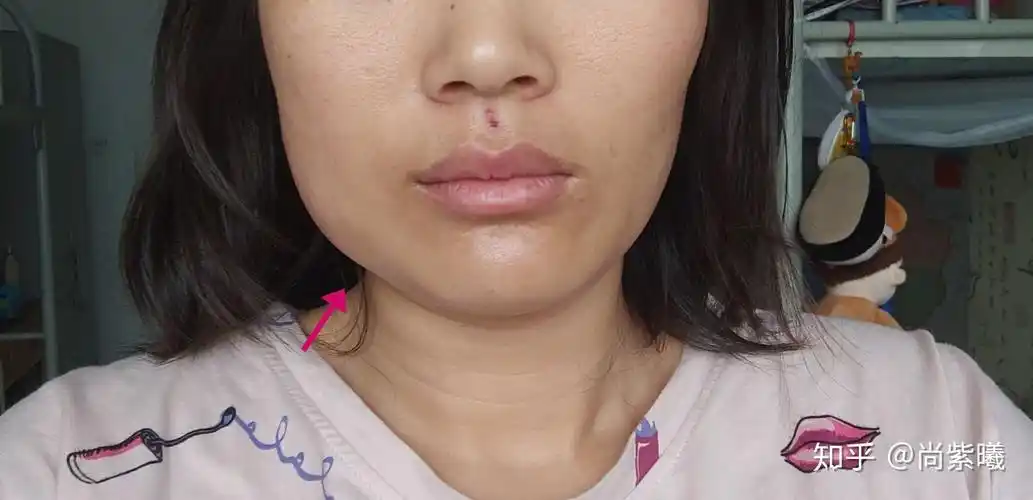 拔智齿脸都要肿成这样么