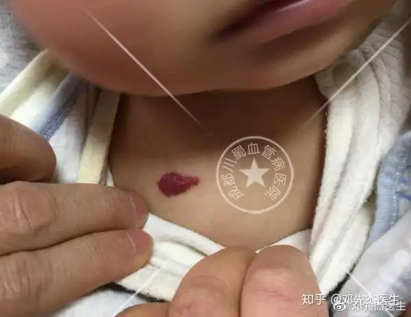 教你1招,轻松识别宝宝身上的红斑,是"血管瘤"还是"鲜红斑痣?