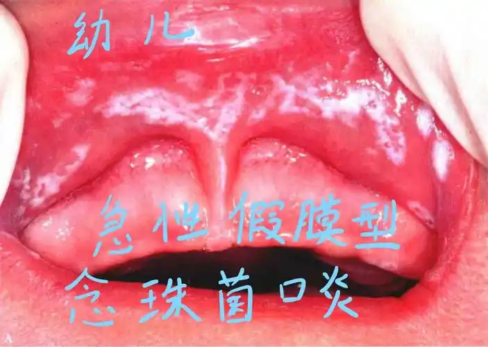 口腔黏膜——慢性增生性念珠菌病的图文介绍 - 好大夫在线