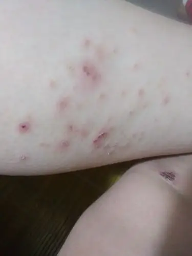 腿上两边都长了这样的东西,去问了医生说是湿疹,然后给我开了擦的药叫