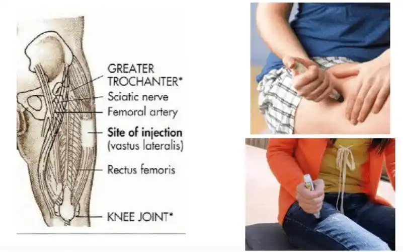 一步走错就酿成医疗纠纷别再被过敏性休克误导了