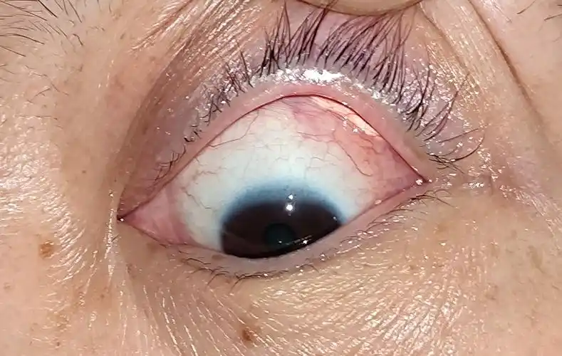 不常见的累及眼球的泪腺炎一例_泪腺炎_泪腺炎介绍 - 好大夫在线