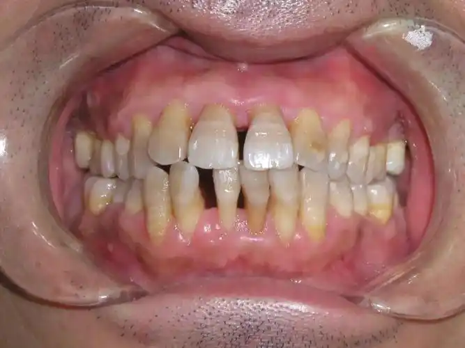 牙龈萎缩,牙根外露02龋坏是渐进性破坏牙齿釉质,牙本质的过程,破坏