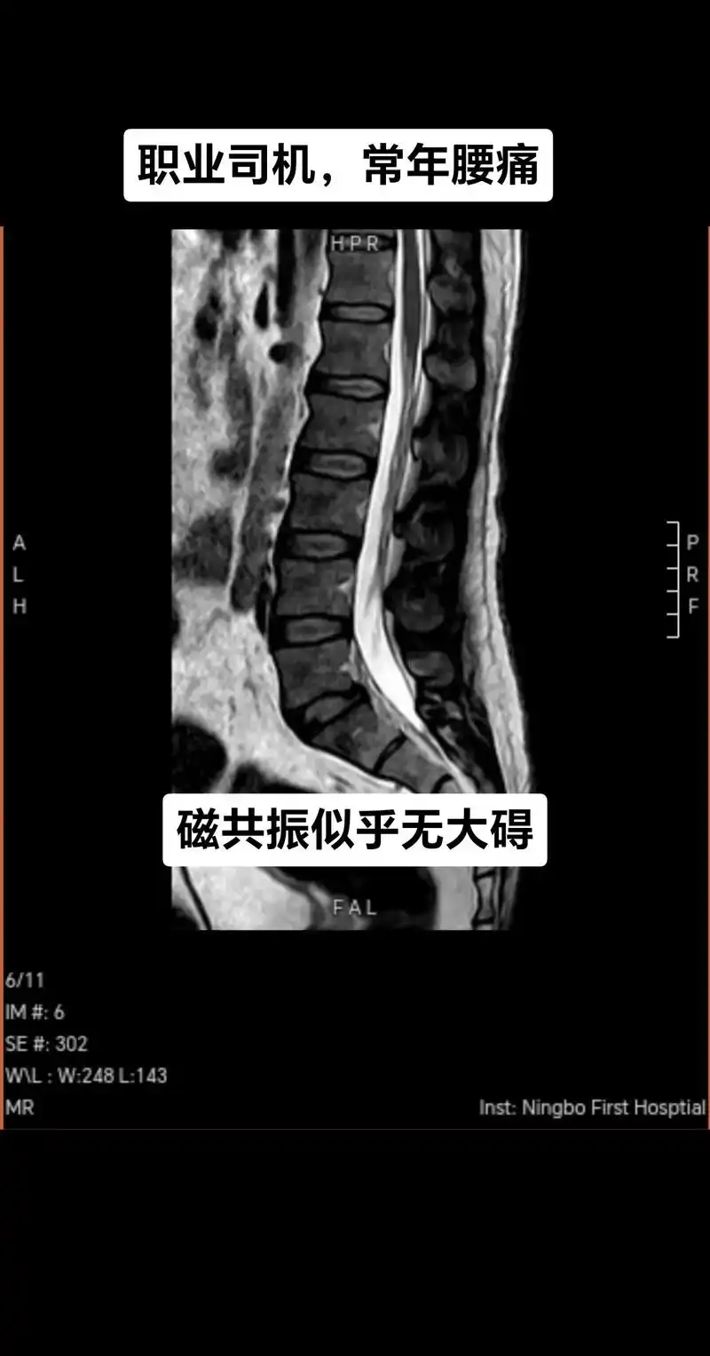 腰痛光做磁共振未必能发现问题.#腰椎间盘突出 #医学影像 # - 抖音