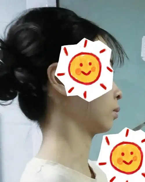 矫正中友友们能看看我的下牙凸吗需要拔吗