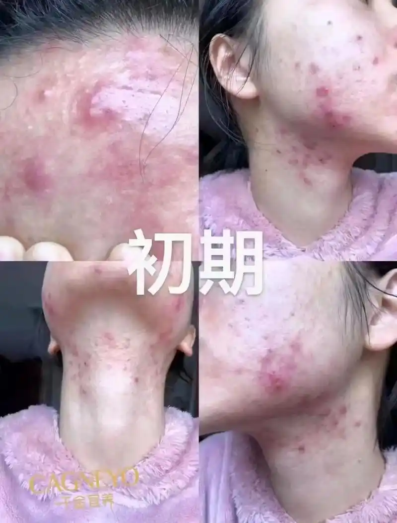 长痘痘真的好恐怖啊!#今日分享  - 抖音