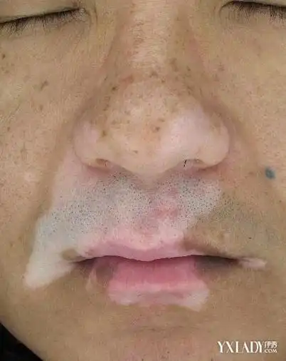 嘴唇出现白癜风 - 好大夫在线