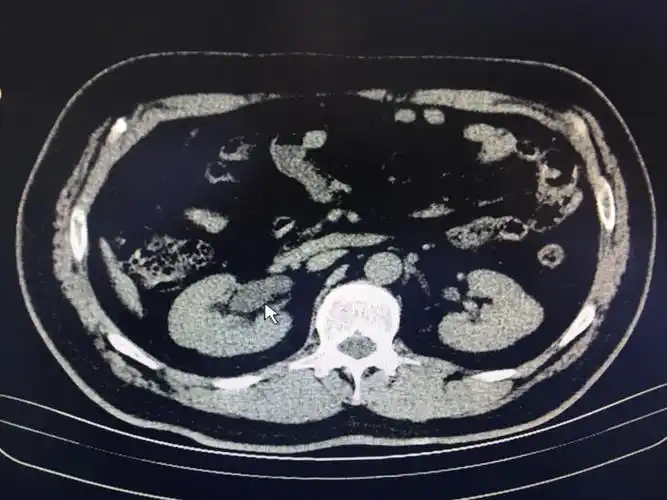 腹部ct扫描提示右肾中度积水,右输尿管扩张明显.