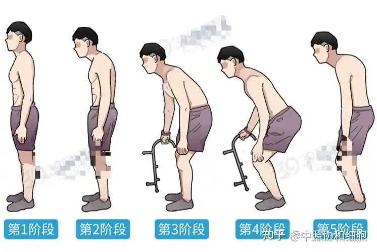 干细胞针对强直性脊柱炎管用吗