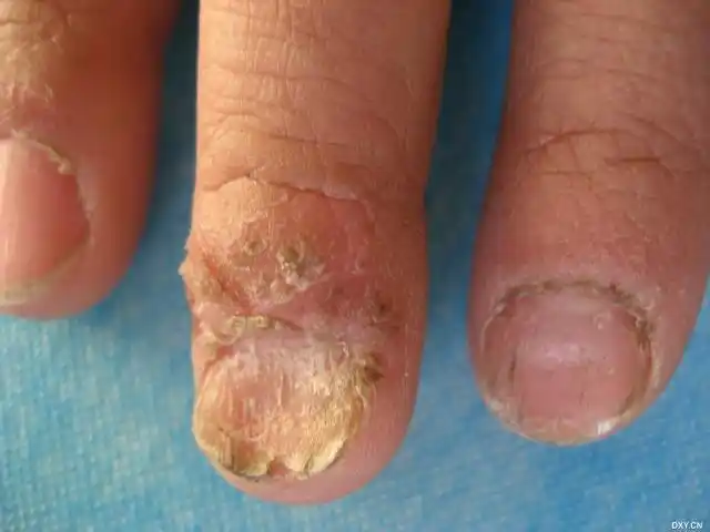 【请教】甲营养不良?