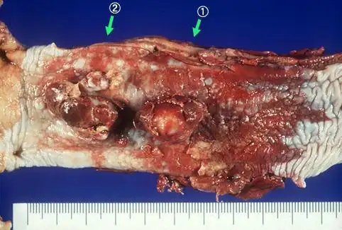 从疾病清单中查看病例 非癌症的肿瘤(恶性,良性) 非癌症的食道肿瘤 癌