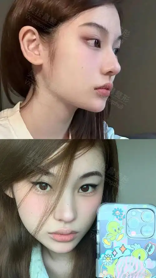 吴松鼻整形##美国射极峰##生活中好看的鼻子##名品鼻三要素##鼻整形