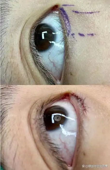 倒睫矫正案例分享