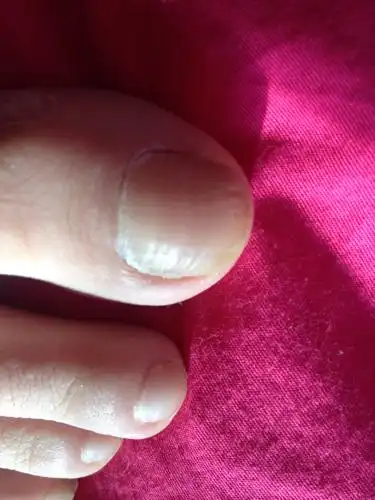 脚趾甲出现横纹是什么原因?如何治疗