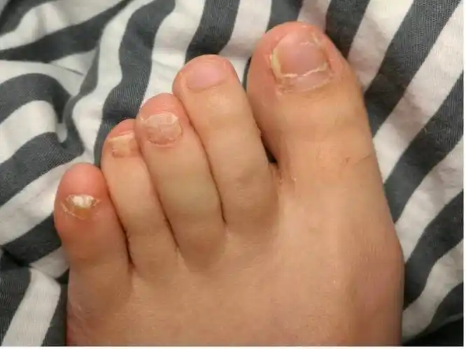 脚趾甲很厚 是灰指甲吗? - 知乎