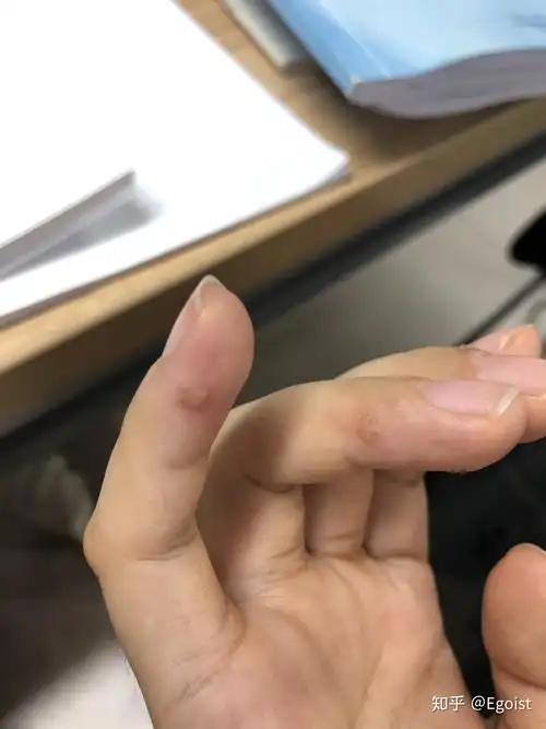 用大蒜去除瘊子的过程记录贴(亲测有效,已治愈)