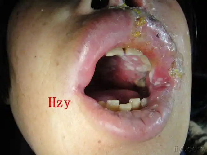 口腔内更厉害公布答案三叉神经第二枝的带状疱疹