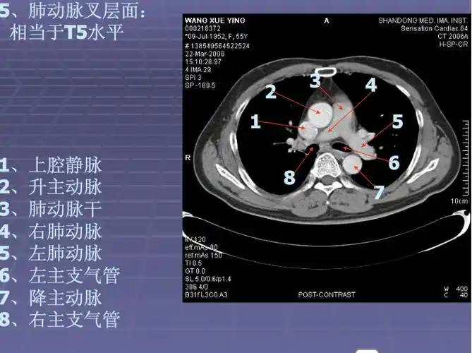 正常胸肺部ct影像学