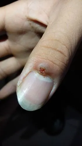 手指长了个包,求救呀