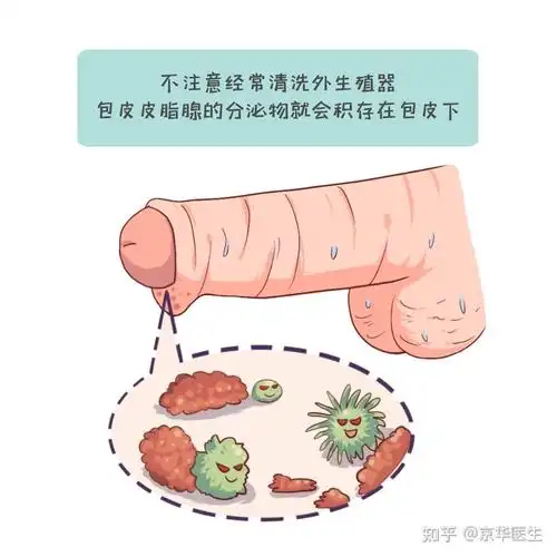 为何男性夏季易感染包皮龟头炎? - 知乎