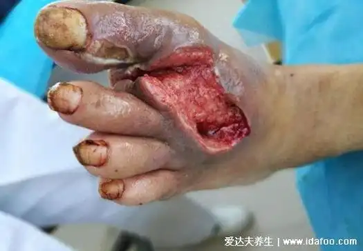 清创是什么意思,清理创口坏死从而加快伤口愈合(图片)