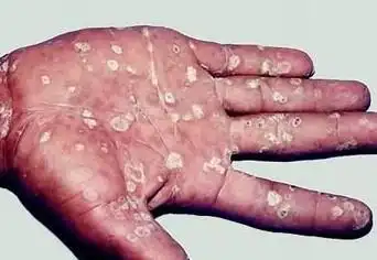 梅毒性白斑就医指南梅毒性白斑的可能疾病可能疾病伴随