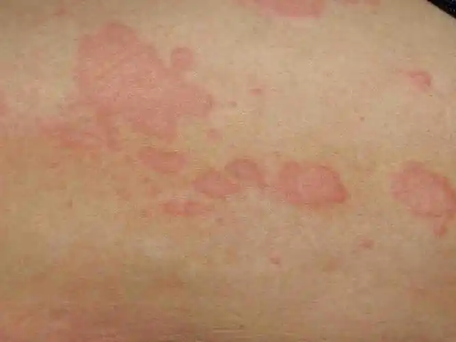 女性红斑狼疮早期症状有哪些呢