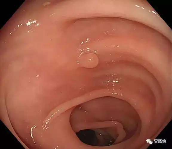 全面解读结直肠息肉你想知道的都在这里