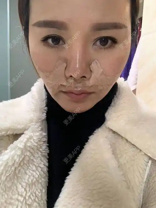 鼻基底,鼻基底效果图_茗茗想回家鼻基底效果图_术后30天__更美