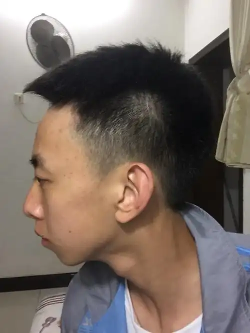 后脑勺凸这么大,很丑很丑怎么办,有没有什么解决方法