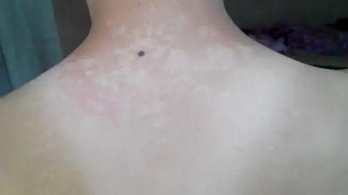 身上脖子那有一片花的,是什么病呢